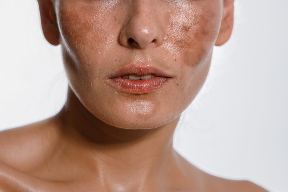 Pigmentation & Melasma