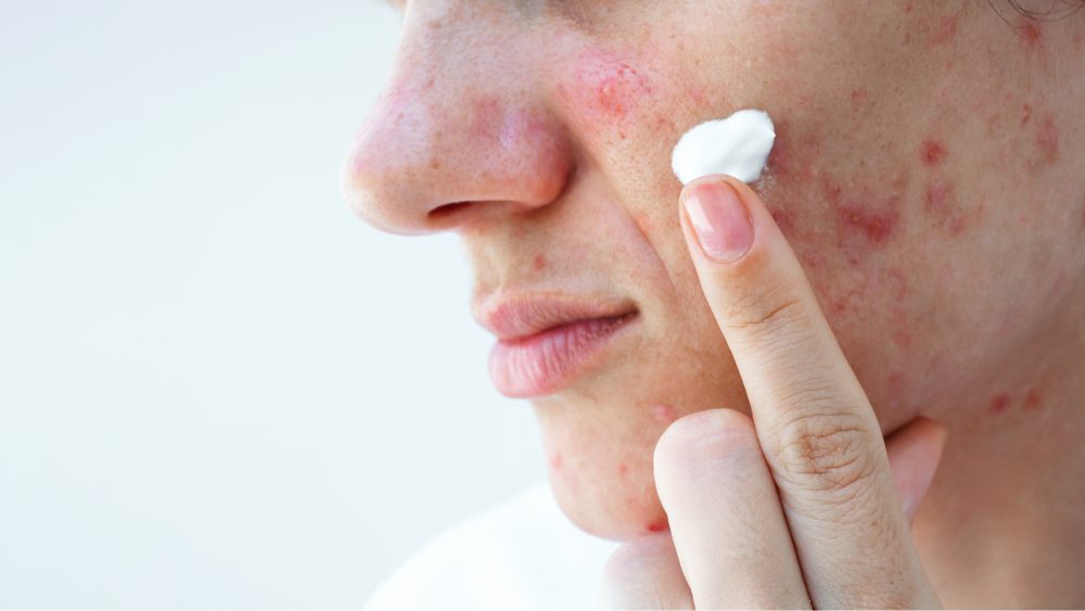Acne