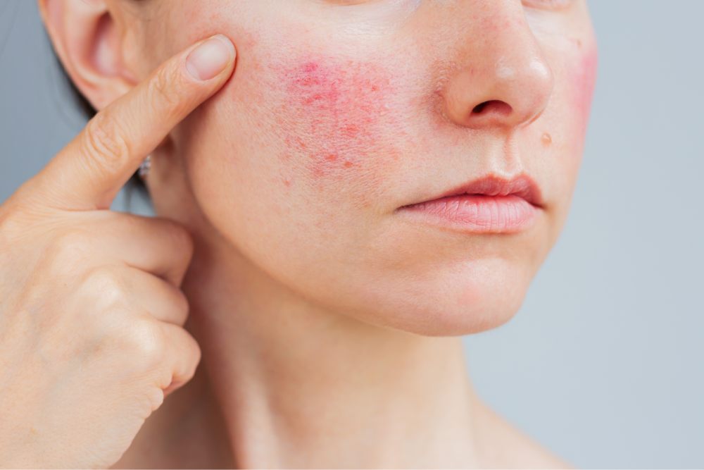 Redness & Rosacea