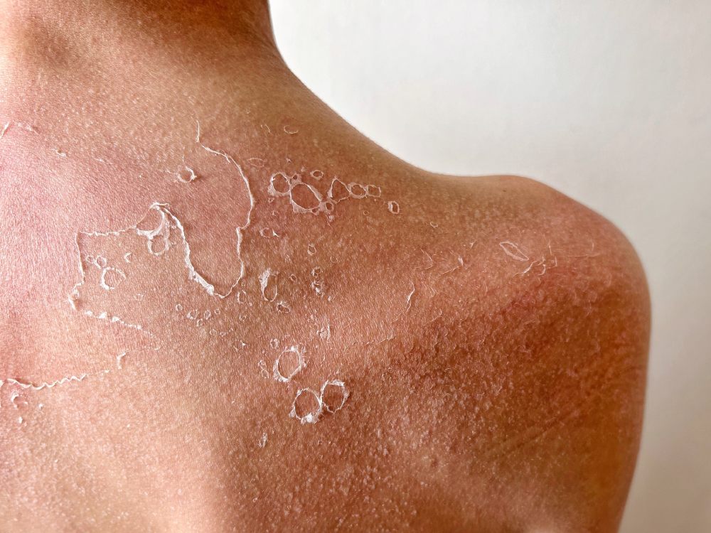 Sun damage